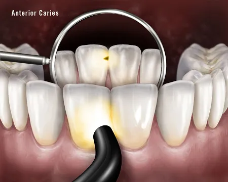 Diagram of a fiberoptic transilluminator detecting anterior caries