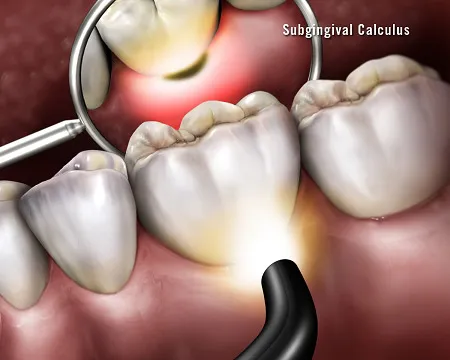 Anterior Caries