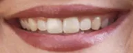 Bright white teeth After teeth whitening
