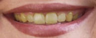 Yellow teeth Before teeth whitening