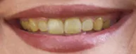 Yellow teeth Before teeth whitening