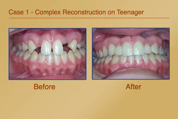 Missing teeth and spacing problem corrected with Complex Reconstruction