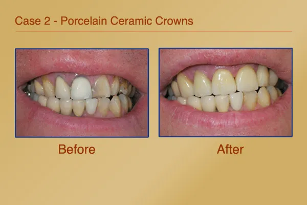 Before & After Porcelain Ceramic Crowns