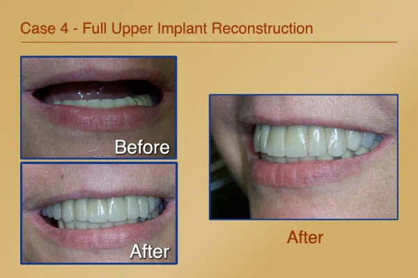 Before & After Full Upper Implant Reconstruction