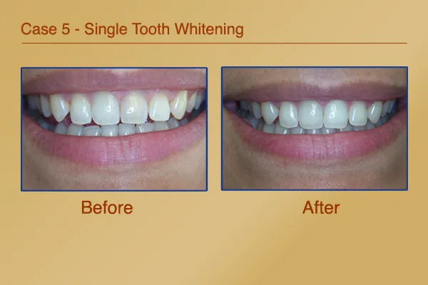 Before & After Single Tooth Whitening