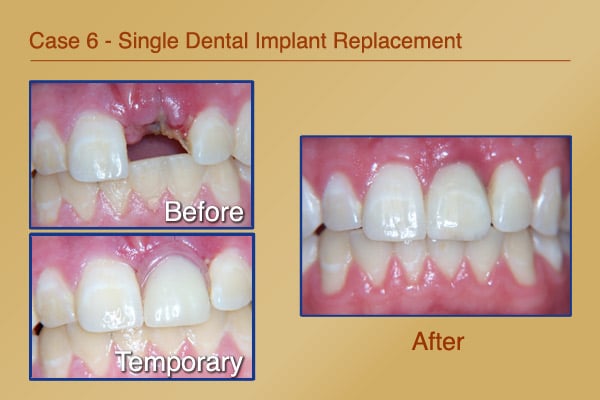 Before & After Photos: Single Dental Implant Replacement