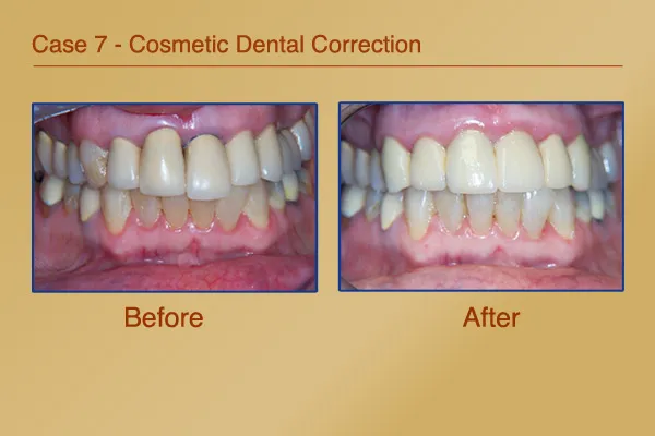 Before & After Cosmetic Dental Correction
