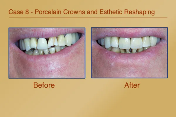 Crooked and chipped teeth corrected with Porcelain Crowns and Esthetic Reshaping