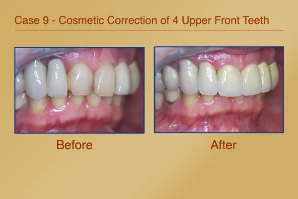 Before & After Cosmetic Correction of 4 Upper Front Teeth