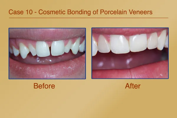 Crooked teeth and a gap fixed with Cosmetic Bonding of Porcelain Veneers