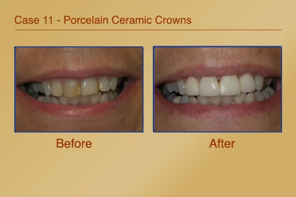 Before & After Porcelain Ceramic Crowns