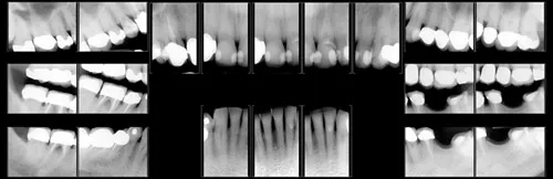Digital x-rays