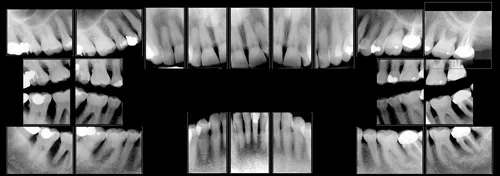 Digital x-rays
