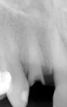 X-ray of a fractured incisor
