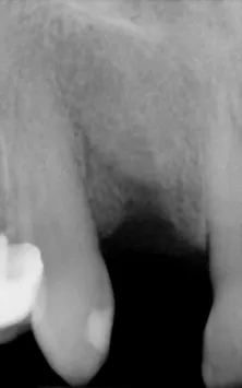 X-ray of a removed upper incisor