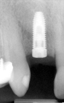 X-ray of a dental implant