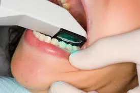 iTero scanner being used in a patient's mouth