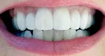 Even smile After porcelain veneers