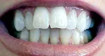 Misshapen teeth Before porcelain veneers