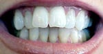 Misshapen teeth Before porcelain veneers