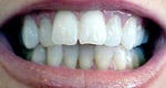 Misshapen teeth Before porcelain veneers