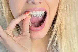 Woman inserting a mouth guard