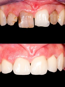 Before and after ceramics
