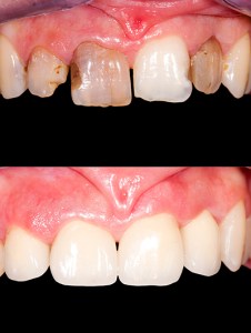 Before and after ceramics
