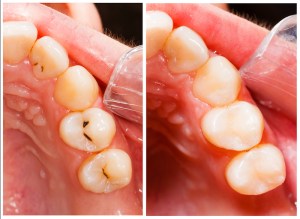 Before and after tooth-colored restoration