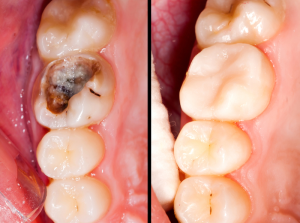 Decayed tooth before and after the placement of composite filling