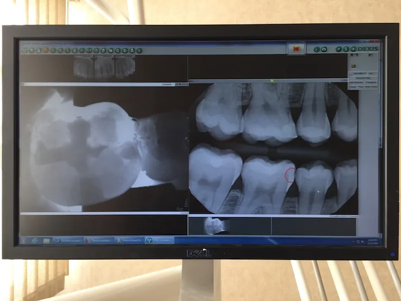 Cari-vu x-rays on a monitor