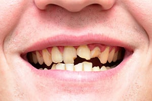 Close-up of mouth with broken teeth