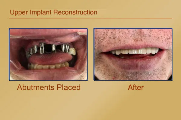 Before & After Upper Implant Reconstruction