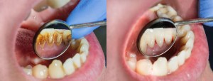Patient's mouth before and after teeth cleaning