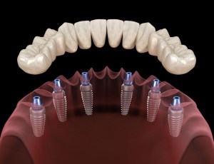 Illustration of dental implants and crowns