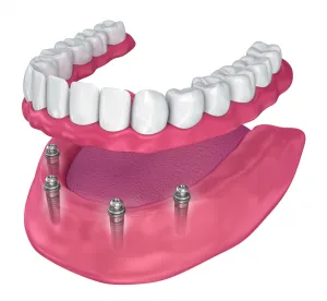 Illustration of Implant Retained Dentures