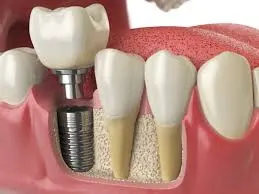 Crown being placed on a dental implant